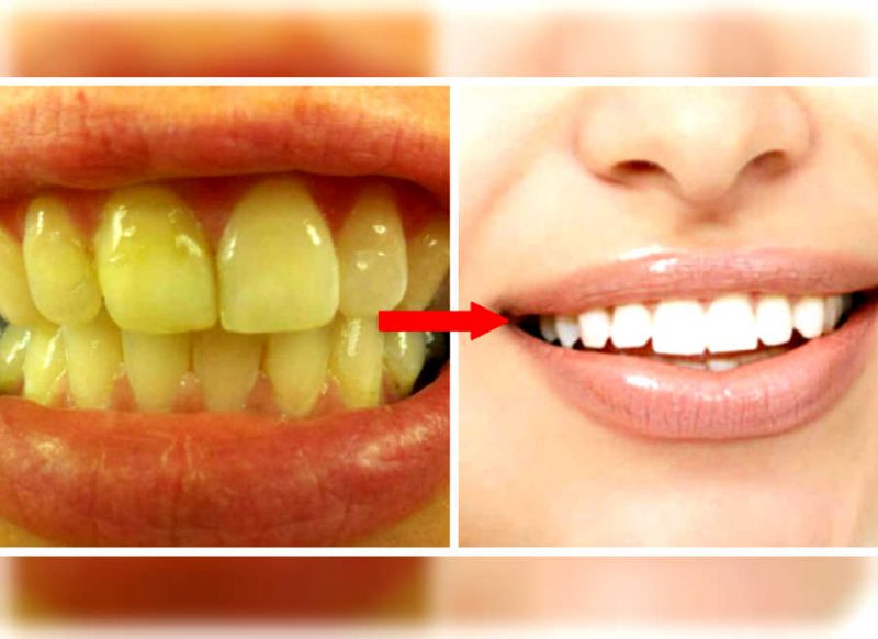 पीले दांतों को सफेद करने के आसान घरेलु नुस्‍खे और उपाय